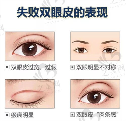 韩国清潭first修复全切双眼皮技术高超,成镇模眼修复自然出血少