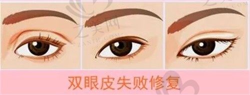 杜园园的双眼皮修复技术怎么样?手术价格列表介绍|上海爱尚丽格医疗美容