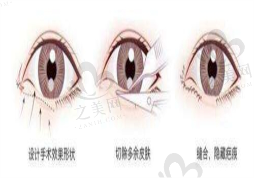 双眼皮手术图
