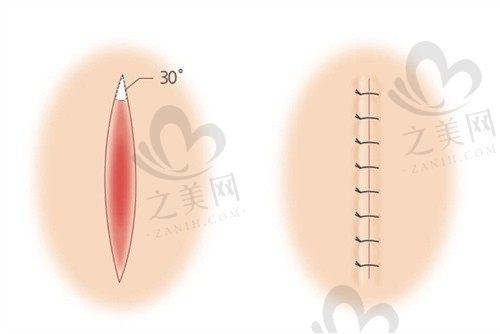 韩国格瑞丝噢爱美疤痕整形方案多样化,痕迹小恢复周期短
