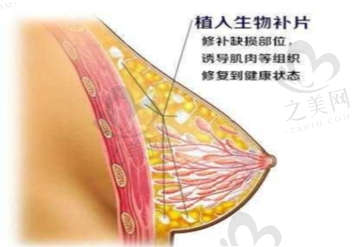 李高峰隆胸手术优势图