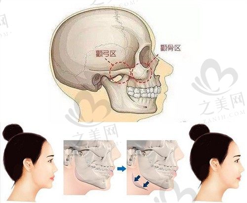 上海做磨骨手术哪家好?上海做下颌骨磨骨手术好的医院前三排名分享