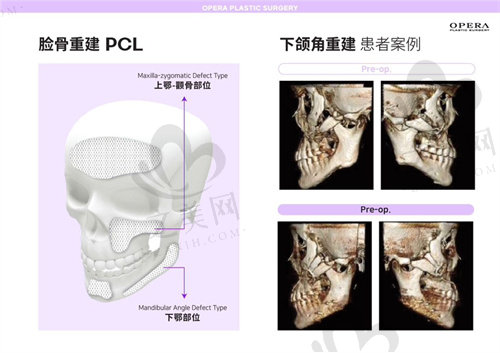 韩国欧佩拉整形PCL下颌角重建