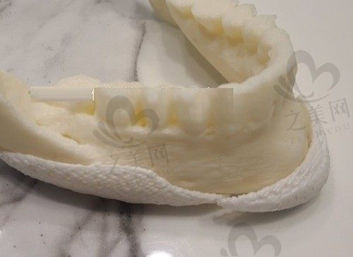 韩国欧佩拉整形医院补骨怎么样?PCL假体补骨技术是一绝价格还不贵