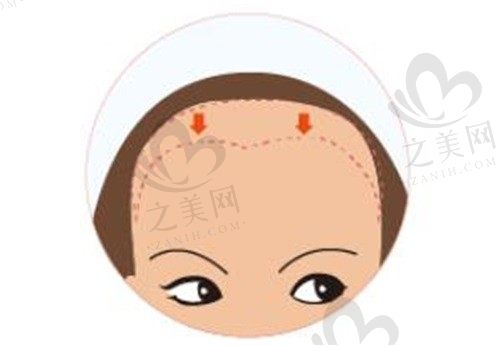 韩国欧佩拉很擅长额头缩小术,无需做发际线种植就可重塑美丽额头