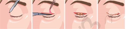 嘉兴曙光医院做双眼皮的手术流程和术后护理