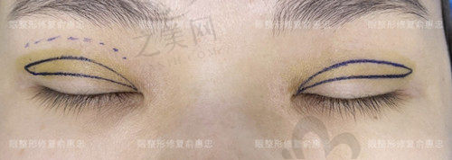 俞惠忠双眼皮修复设计