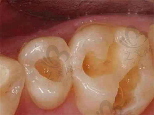 大连洁雅口腔牙髓治疗价格揭秘