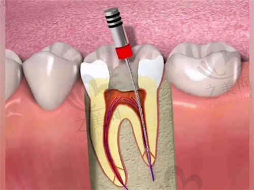 大连洁雅口腔牙髓治疗价格揭秘