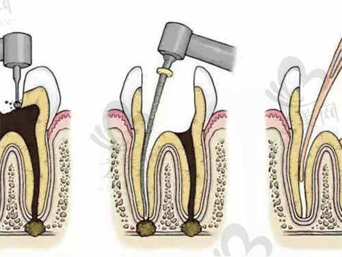 大连洁雅口腔牙髓治疗价格揭秘