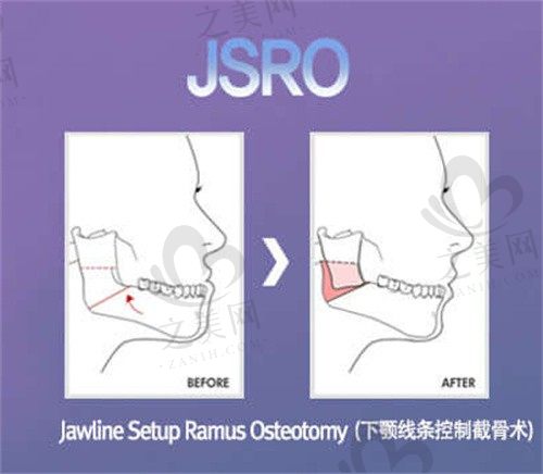 韩国菲斯莱茵整形外科凸嘴双颚技术精良,李真秀JSRO智能双颚风险低