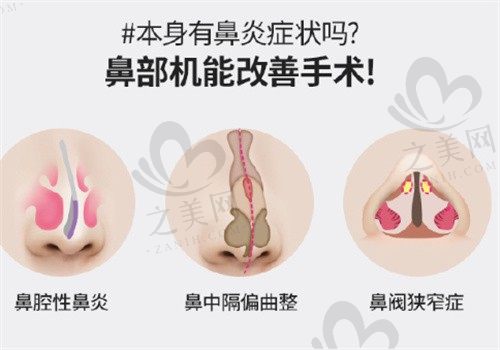 韩国ID医院鼻修复技术深得人心,金一焕耳软骨鼻修复自然出色