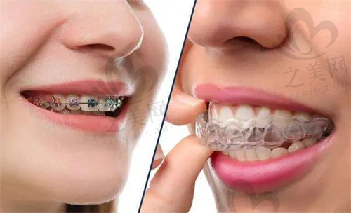 南通沪牙卫士口腔牙齿矫正多少钱？