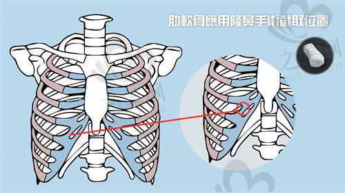 全肋骨隆鼻的优势是什么？