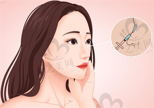 广州艺星蒋思军做鼻子技术不赖,价格2—6w起口碑靠谱值得信赖