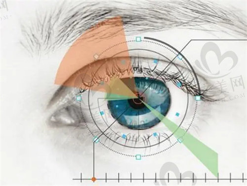 杭州爱尔眼科医院做屈光手术的医生推荐