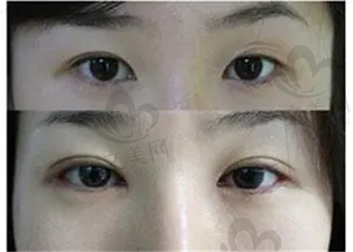 上海时光医院2024年双眼皮典型成功案 例