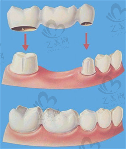 廊坊燕郊晶颜口腔牙国产牙冠与进口牙冠的区别有哪些？