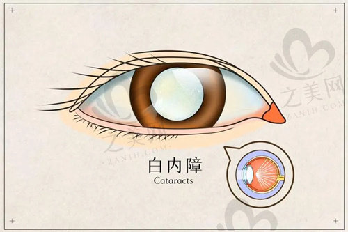 上海和平眼科白内障手术怎么样?