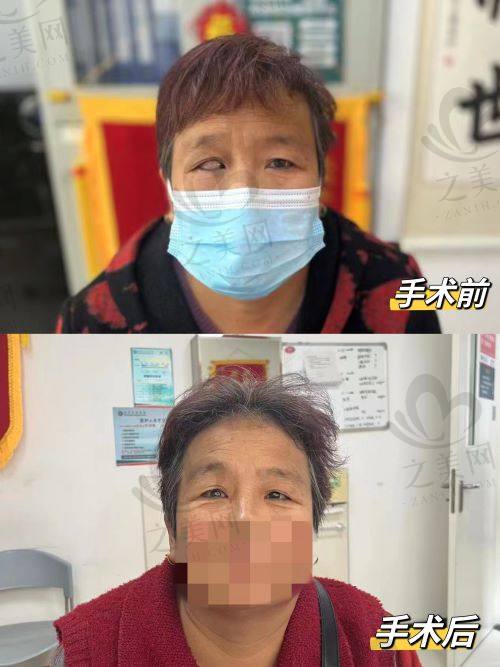 上海和平眼科医院白内障手术前后