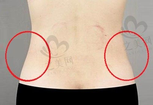 韩国365mc吸脂整形医院怎么样?技术高且价格不贵是有亲身经历为证