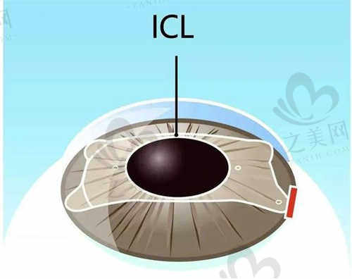 西京医院眼科ICL晶体植入术