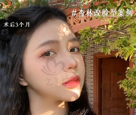 正颌手术沈阳哪个医院做的好?沈阳杏林和沈阳北方做的好有朱石江&刘晓光