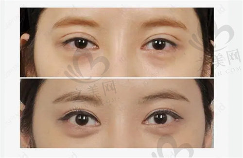 上海爱尚丽格医疗美容双眼皮修复手术好不好?