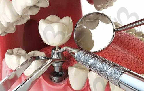 我在陕西榆林优牙口腔医院进行的种植牙手术经历分享