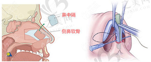 上海伊莱美医疗美容医院隆鼻手术价格