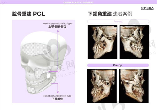 韩国欧佩拉整形pcl补骨材料设计