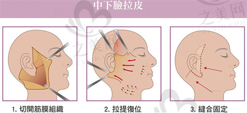 台州维多利亚医院面部提拉价格