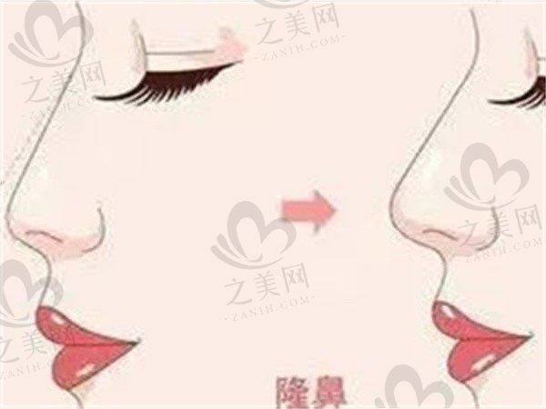 王旭明医生做鼻子好吗?技术很赞是做隆鼻和鼻修复大师级的医生
