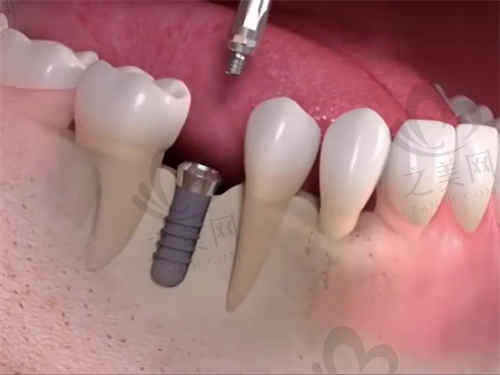 广州好大夫口腔医院种植牙多少钱一颗?