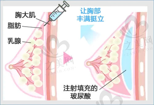 北京嘉禾医院玻尿酸丰胸好不好