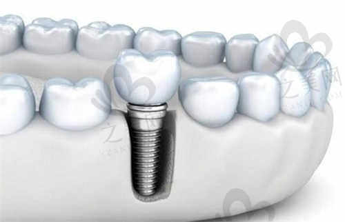 重庆美奥口腔医院种植牙