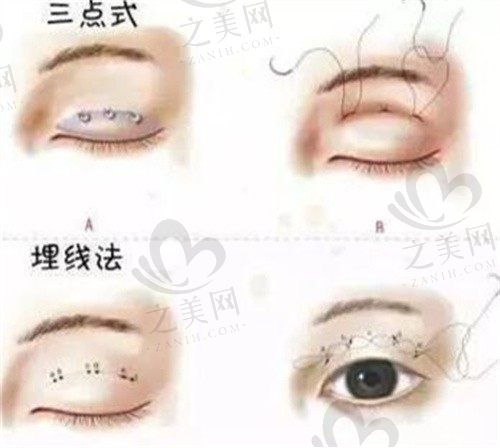 韩国必当归双眼皮整形柳济圣亲诊,个性化设计风格自然术后不留疤