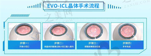 廊坊爱尔眼科ICL手术价格