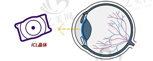 哈尔滨普瑞眼科医院ICL手术价格