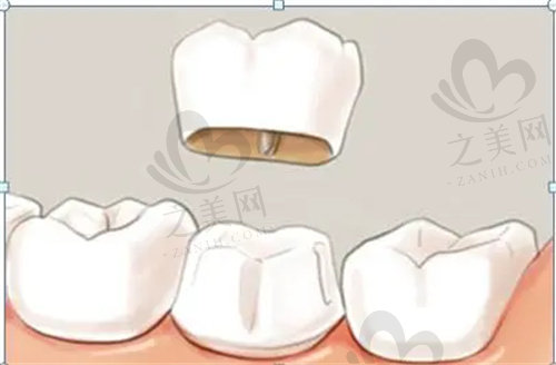 缺牙的3种修复方式