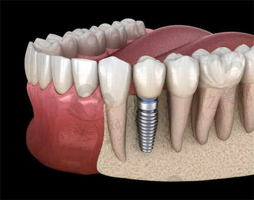 淮北博爱口腔医院种植牙