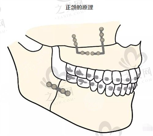 我在广州广大整形医院做了正颌手术,术后效果惊艳了亲朋好友