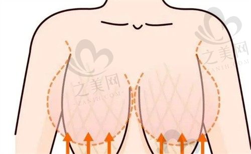 西安叶子医疗美容隆胸做的好吗?找李杨医生技术口碑真的好