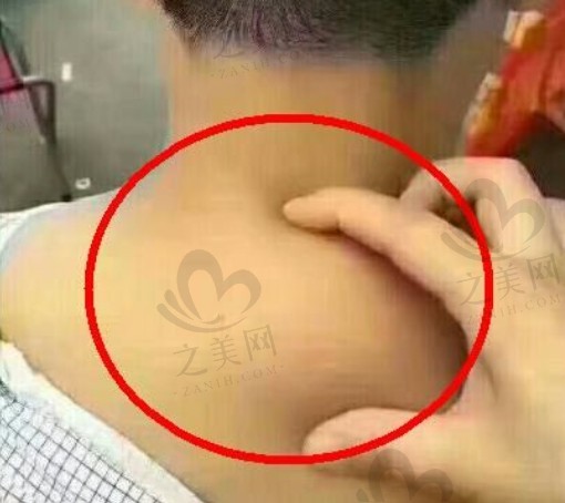 黄学锋消除富贵包是真的吗?是真的,一针消除富贵包成效好不易反弹