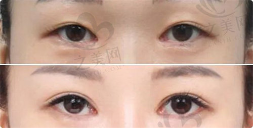 王良发医生做双眼皮手术怎么样？
