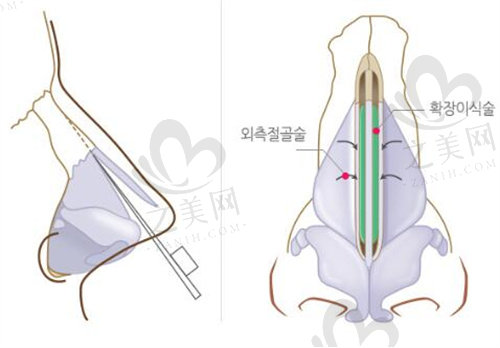 韩国格瑞丝整形外科驼峰鼻矫正