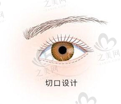 韩国大眼睛整形外科切口设计