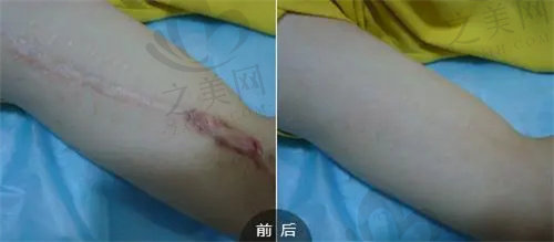 广东药科大学附属第三医院疤痕修复医生