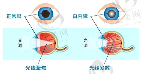 白内障与正常眼睛的区别