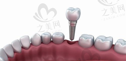 上海沪申五官科种植牙价格